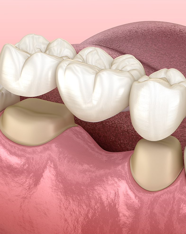 Treatment -  Heralds Way Dental