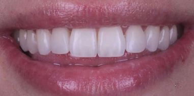 After - Heralds Way Dental