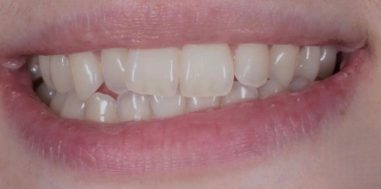Before - Heralds Way Dental