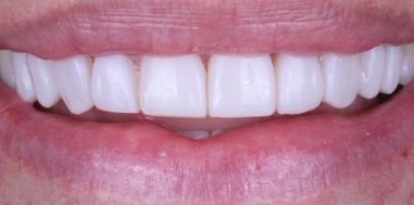After - Heralds Way Dental