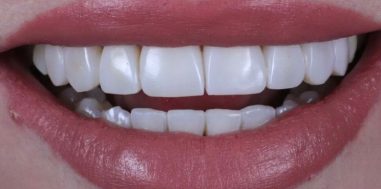 After - Heralds Way Dental