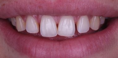 Before - Heralds Way Dental