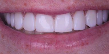 After - Heralds Way Dental
