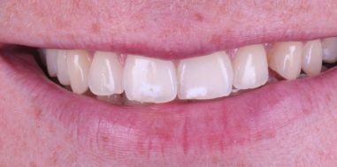 Before - Heralds Way Dental