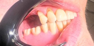 Before - Heralds Way Dental