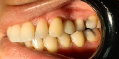 After - Heralds Way Dental