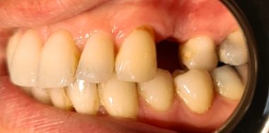 Before - Heralds Way Dental